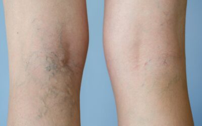 What You Need To Know About Varicose Vein Treatments This Year